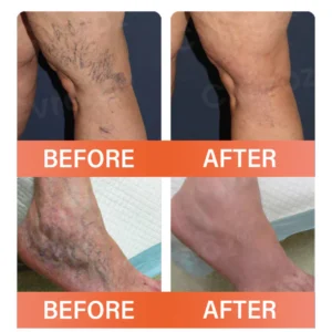 Oveallgo® VeinEase Microneedle Therapy Patch