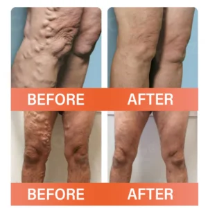 Oveallgo® VeinEase Microneedle Therapy Patch