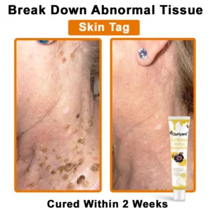 Ourlyard® Bee Venom Wart Removal Cream 12 Ourlyard® Bee Venom Wart Removal Cream