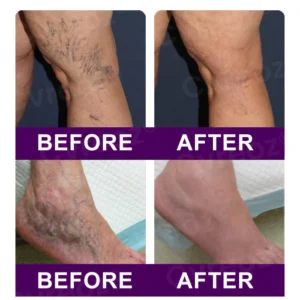 Cvreoz® Polidocanol Nano Patches for Varicose Veins