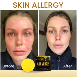 AEXZR® Bee Venom Skin Treatment Soap