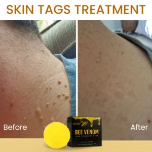 AEXZR® Bee Venom Skin Treatment Soap
