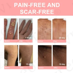 Fivfivgo® Dual Acid Wart & Mole Removal Serum