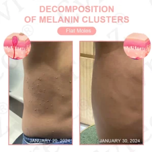 Fivfivgo® Dual Acid Wart & Mole Removal Serum