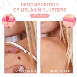 Fivfivgo® Dual Acid Wart & Mole Removal Serum