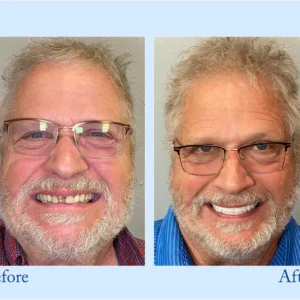 HERMSA® Advanced Customized Full Denture Set