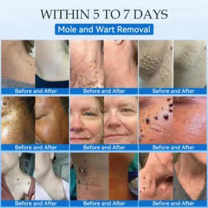 Jasseem® Non-Invasive Mole & Wart Laser Removal Pen