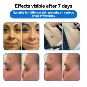 Jasseem® Non-Invasive Mole & Wart Laser Removal Pen