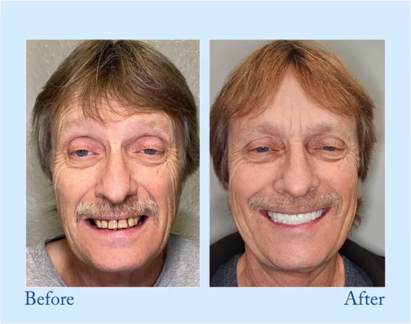 HERMSA®  Advanced Customized Full Denture Set - Image 4