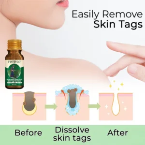Fivfivgo® Bacteriostatic Black Cumin Skin Tag Remover