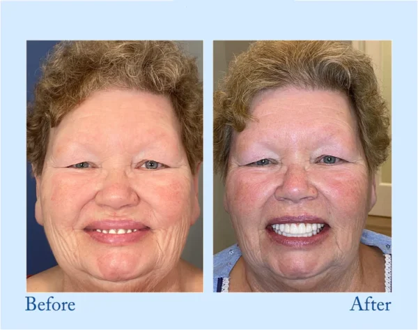 HERMSA®  Advanced Customized Full Denture Set - Image 6