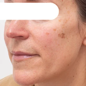 Fivfivgo® Herbal Spots Peel-Off Facial Mask