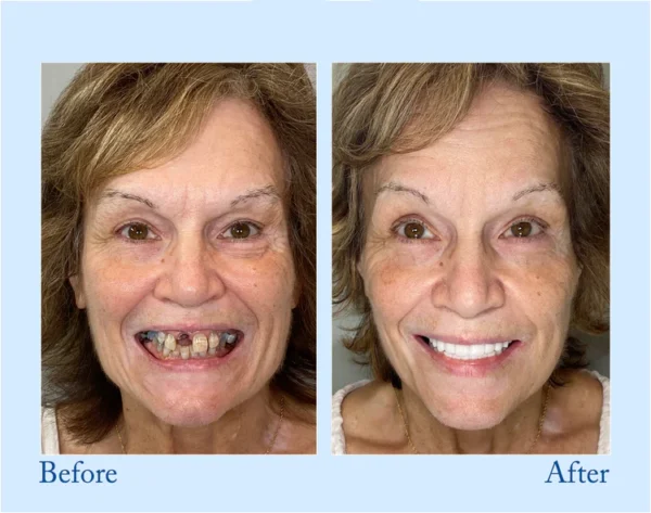 HERMSA®  Advanced Customized Full Denture Set - Image 7