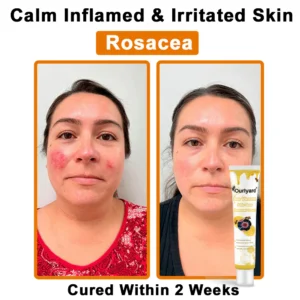 Ourlyard® Bee Venom Wart Removal Cream 14 Ourlyard® Bee Venom Wart Removal Cream