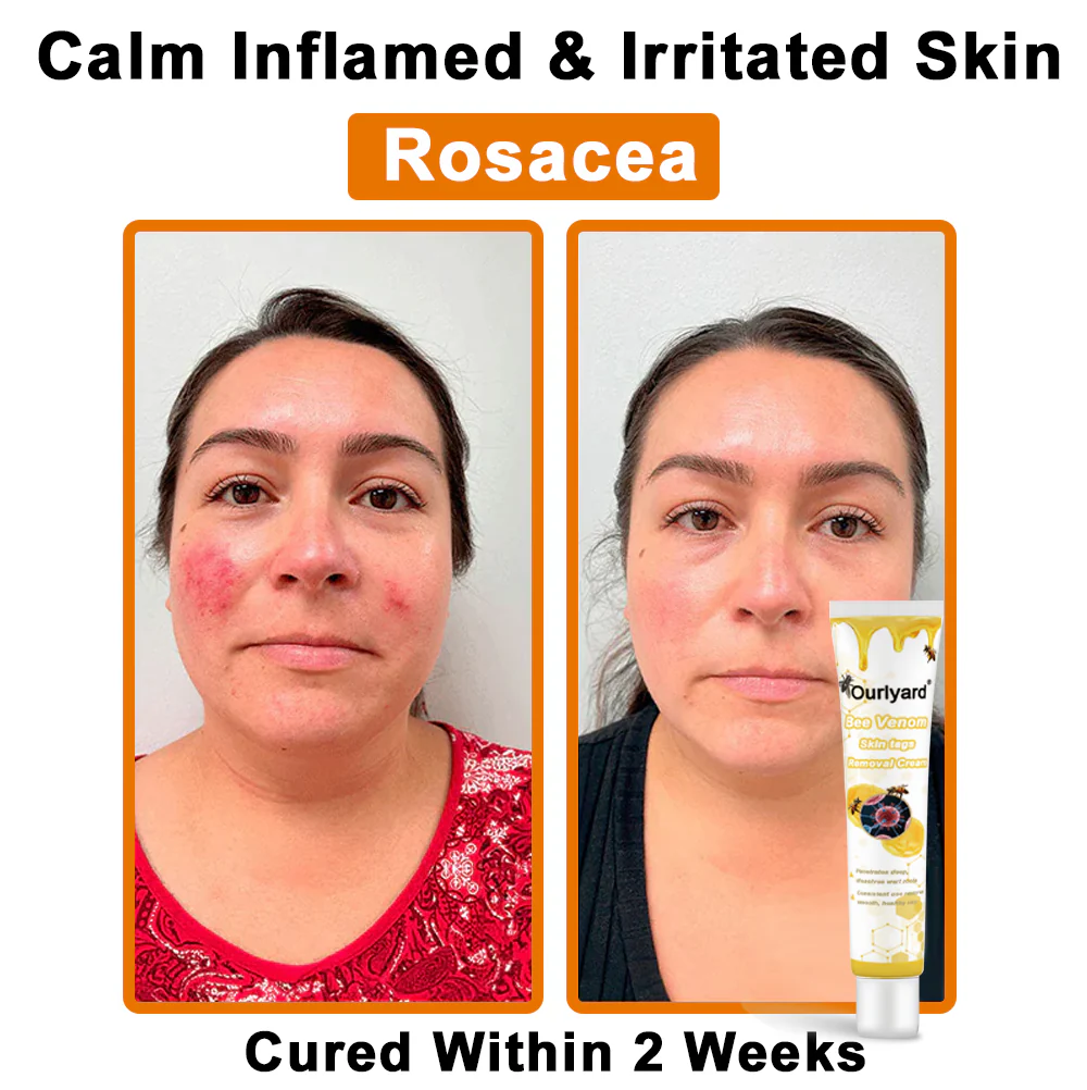 Ourlyard® Bee Venom Wart Removal Cream 6 Ourlyard® Bee Venom Wart Removal Cream - Image 6