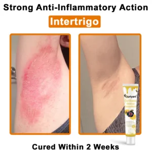 Ourlyard® Bee Venom Wart Removal Cream 15 Ourlyard® Bee Venom Wart Removal Cream