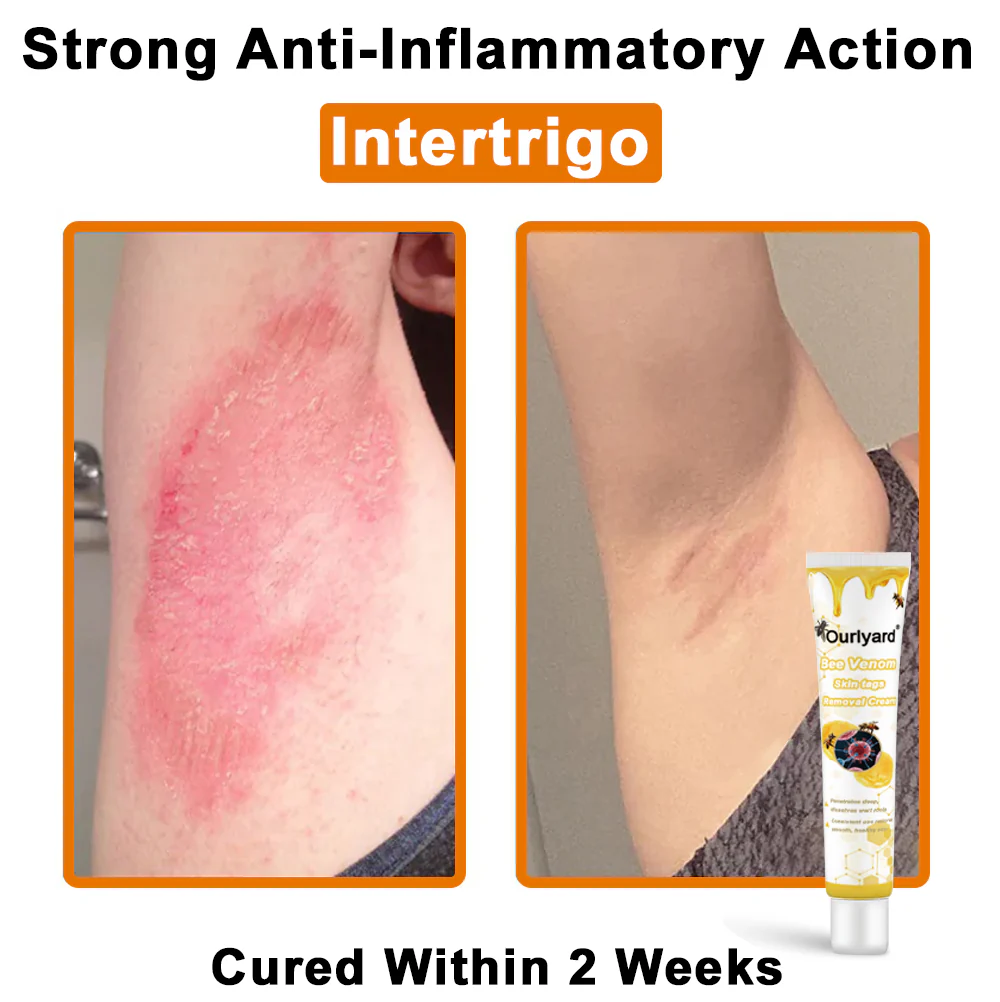 Ourlyard® Bee Venom Wart Removal Cream 7 Ourlyard® Bee Venom Wart Removal Cream - Image 7