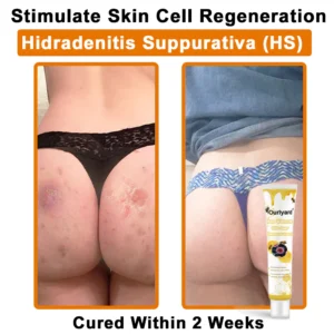 Ourlyard® Bee Venom Wart Removal Cream 13 Ourlyard® Bee Venom Wart Removal Cream