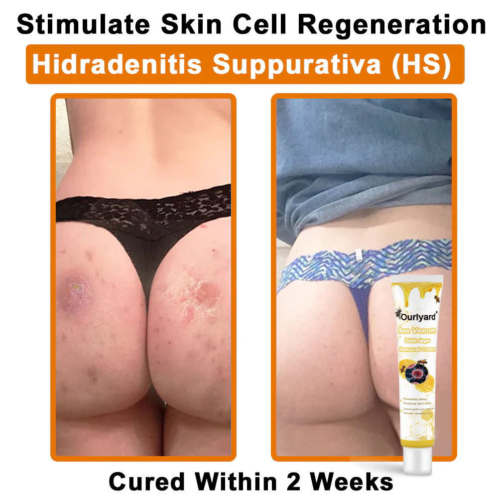 Ourlyard® Bee Venom Wart Removal Cream 5 Ourlyard® Bee Venom Wart Removal Cream - Image 5