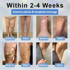 ATTDX® Black Cumin Edema Soothing Herbal Cream 15 ATTDX® Black Cumin Edema Soothing Herbal Cream