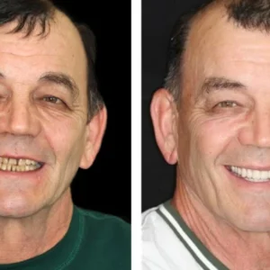 Premium Comfort Denture Set™