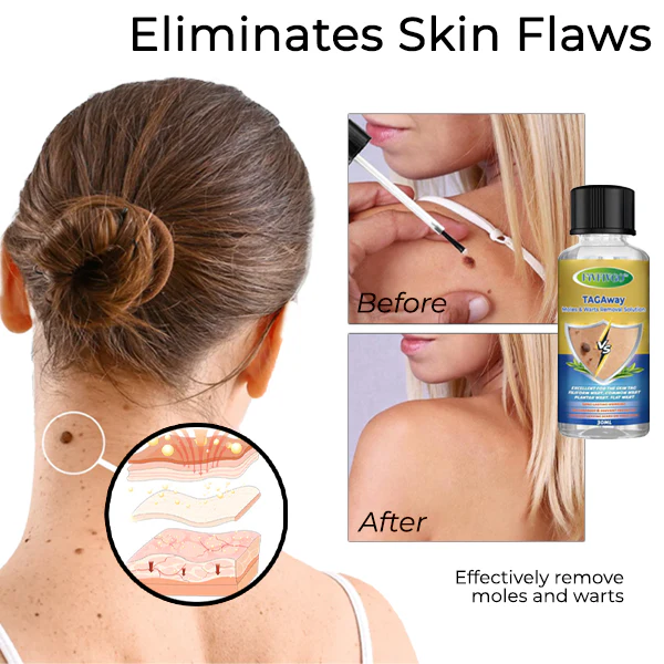 Fivfivgo™ TAGAway Moles & Warts Removal Solution 3 Fivfivgo™ TAGAway Moles & Warts Removal Solution