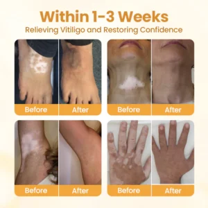 Oveallgo® VitiClear Pro Bee Venom Cream