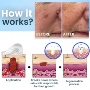 Cvreoz® Nano-Micro Needle Skin Tags Removal Patches