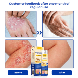 SkinClix™ | Effectively relieves itching and flaking and improves the appearance of psoriatic skin by up to 95% within just a few weeks
