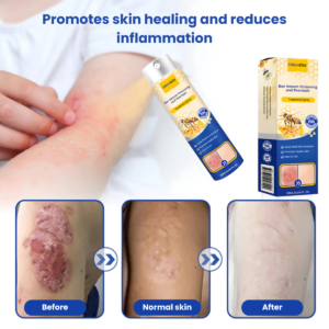 SkinClix™ | Effectively relieves itching and flaking and improves the appearance of psoriatic skin by up to 95% within just a few weeks