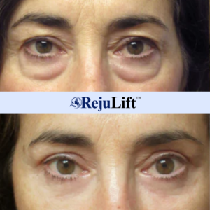 RejuLift™ Lifting Serum | Facelift without Botox – in just 7 days!