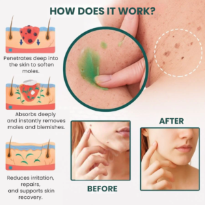 SilkSkin™ | Clinically Proven to Remove 97% of Moles, Warts & Blemishes