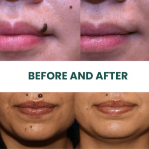SilkSkin™ | Clinically Proven to Remove 97% of Moles, Warts & Blemishes