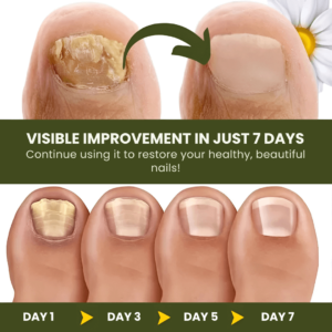 NailCure™ Fungal Nail Drops