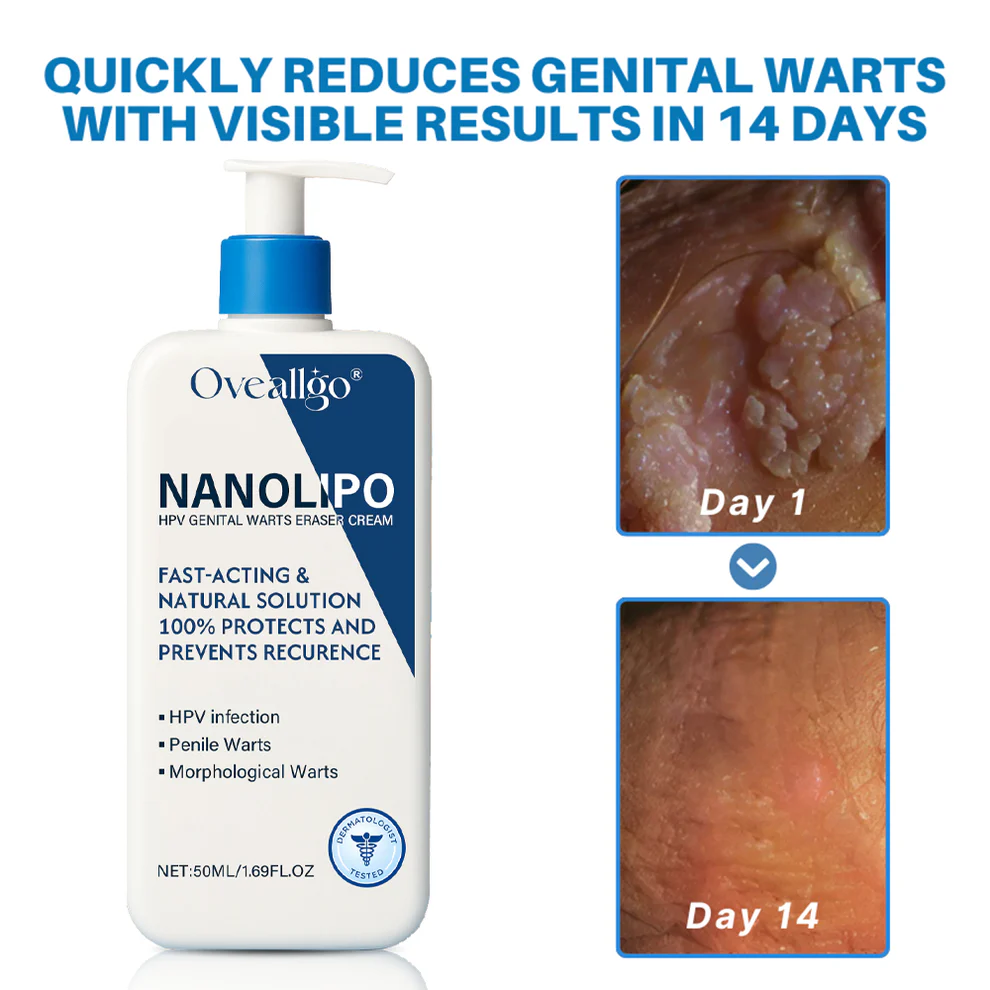 Oveallgo® NanoLipo HPV Genital Warts Eraser Cream Ultra 2 Oveallgo® NanoLipo HPV Genital Warts Eraser Cream Ultra