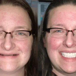 HZA™ Custom-Fit Functional Dentures