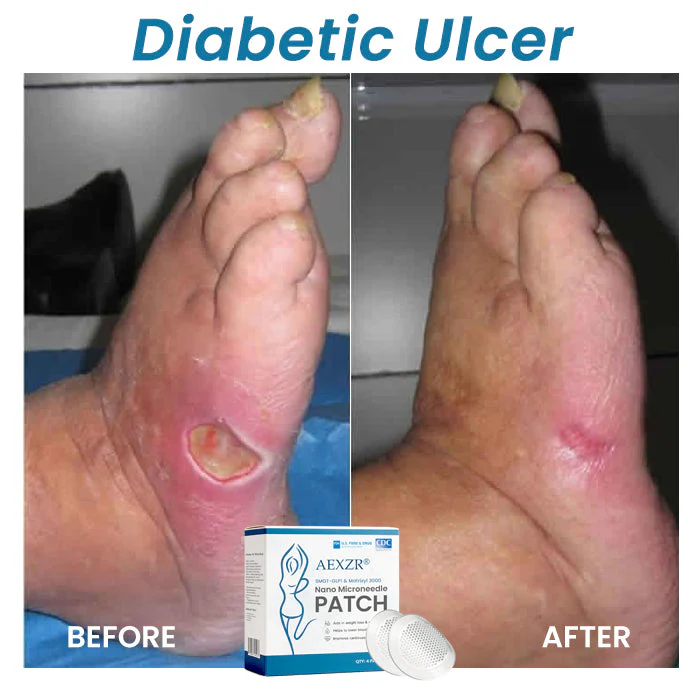 AEXZR® SMGT-GLP1 & Matrixyl 3000 Nano Microneedle Patch 9 AEXZR® SMGT-GLP1 & Matrixyl 3000 Nano Microneedle Patch - Image 9