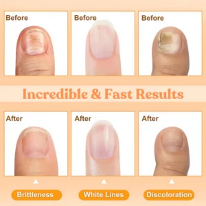 AEXZR® Bee Venom Nail Repair Treatment Spray