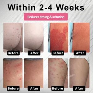 ATTDX® FemGuard Genital HPV Care Spray