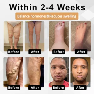 ATTDX® CortiEase Hormonal Swelling Balance Cream 14 ATTDX® CortiEase Hormonal Swelling Balance Cream