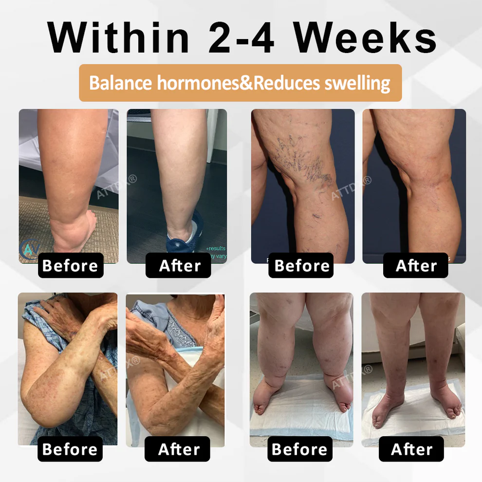 ATTDX® CortiEase Hormonal Swelling Balance Cream 3 ATTDX® CortiEase Hormonal Swelling Balance Cream