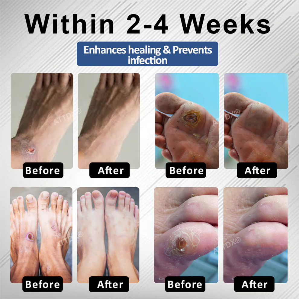 ATTDX® Diabetes Foot Guard Fast Recovery Spray 3 ATTDX® Diabetes Foot Guard Fast Recovery Spray