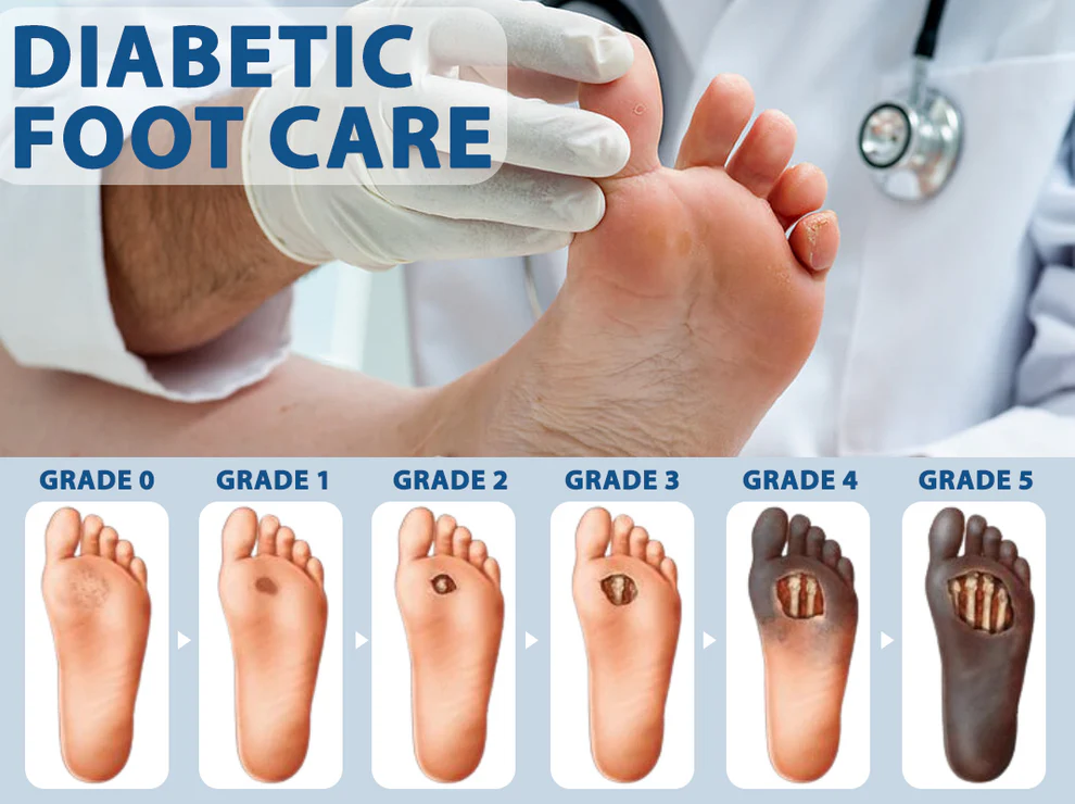 ATTDX® Diabetes Foot Guard Fast Recovery Spray 8 ATTDX® Diabetes Foot Guard Fast Recovery Spray