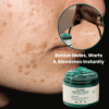 SilkSkin™ | Clinically Proven to Remove 97% of Moles, Warts & Blemishes