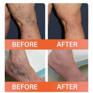 YUNPSO™ MicroVeno Microneedle Therapy Patch