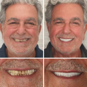 HZA™ Custom-Fit Functional Dentures