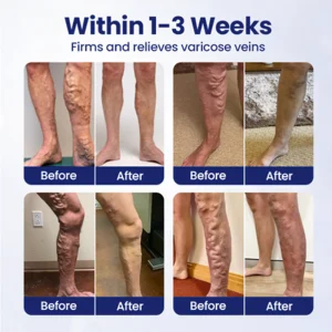 Furzero® VeinFreedom Herbal Spray - MicroMist Therapy