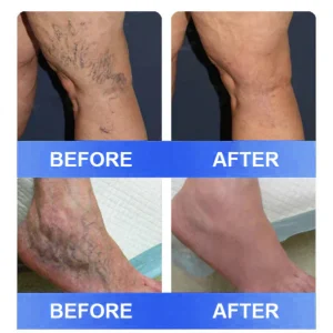 Ourlyard® Vein Ease Microneedle Care Patch - Cuttable