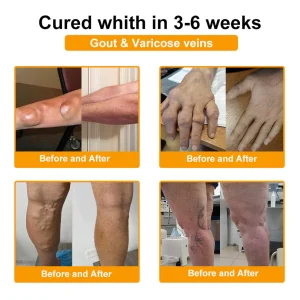 Raindew® Botulinum Toxin & Bee Venom Pain-Relief Bone Healing Cream