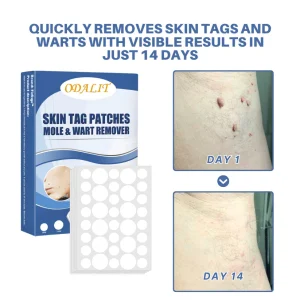 ODALIT™ Moles & Warts Removing Skin Tag Patch